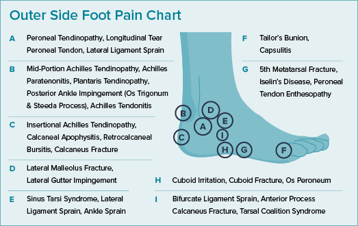 This illustration shows the outside of a foot with callouts showing the location and names of painful conditions. 