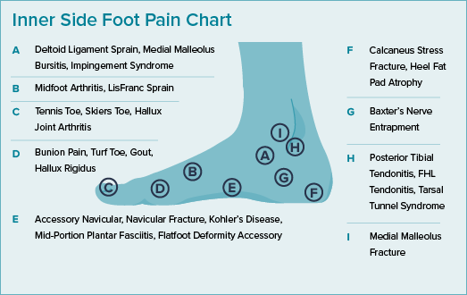 This illustration shows the inner side of a foot with callouts showing the location and names of painful conditions. 