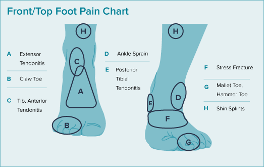 This illustration shows the front and top of a foot with callouts showing the location and names of painful conditions. 